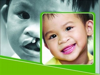 Tháng 3: Phẫu thuật miễn phí cho trẻ em bị dị tật môi tại Hà Nội