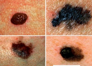 Ung thư da và những cảnh báo không thể xem thường