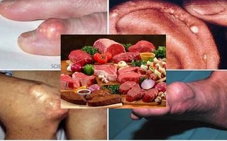 Người bị bệnh gout không nên ăn thực phẩm gì?