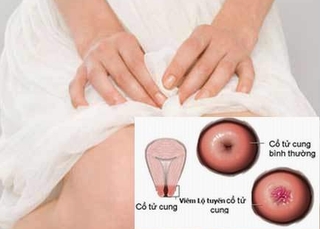 Hiểu đúng về viêm lộ tuyến cổ tử cung