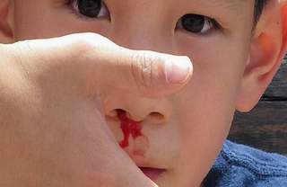 Cách phòng và điều trị chảy máu cam ở trẻ