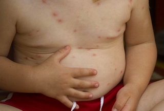 Hà Nội: Thiếu vắcxin thủy đậu tiêm chủng cho trẻ