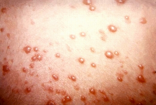 Một số điều có thể bạn chưa biết về bệnh thủy đậu