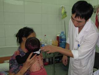Hà Nội:Số ca mắc thủy đậu đột ngột tăng cao
