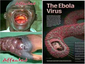 Ai dễ  nhiễm bệnh sốt xuất huyết do vi rút Ebola?