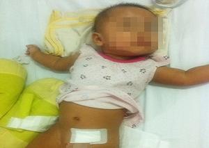 Bé gái 6 tháng tuổi bị cắt bỏ một buồng trứng vì thoát vị bẹn