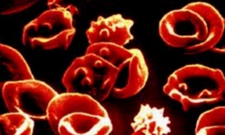 Bệnh tan máu bẩm sinh có nguy hiểm?