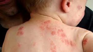 Trẻ bị viêm da do kiến ba khoang tăng đột biến