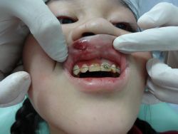 Hy hữu: Bé gái 11 tuổi rách môi do mắc cài chỉnh răng