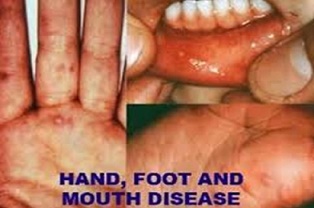 Biện pháp “ngừa” bệnh chân tay miệng cho trẻ