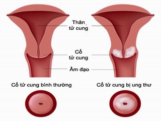 Mỗi ngày có 9 phụ nữ Việt chết vì ung thư cổ tử cung
