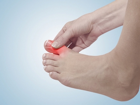 Dấu hiệu ở bàn chân: ngón cái sưng to cảnh báo bệnh Gout