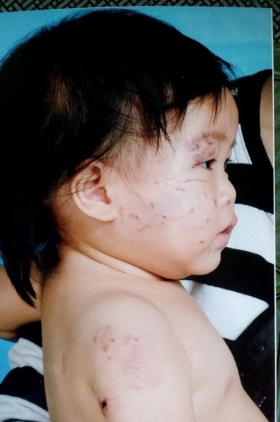Bé 11 tháng tuổi bị nhiều vết thương sau khi đi trẻ