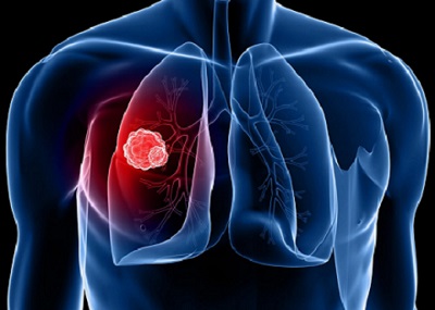 Cách phát hiện sớm các triệu chứng của ung thư phổi