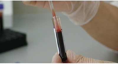 Chỉ 1 xét nghiệm máu đơn giản có thể phát hiện tất cả các loại ung thư?