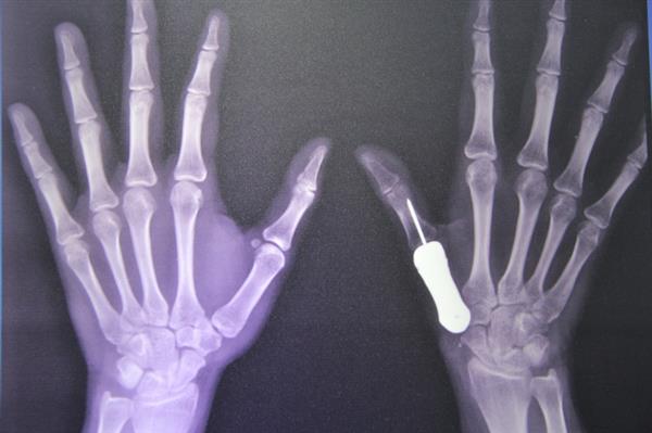Hình chụp bàn tay của bệnh nhân sau khi được ghép xương titan. Ảnh: The Nation/ANN.