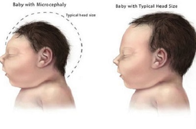 Bệnh do virus Zika đã lây lan ra 36 nước