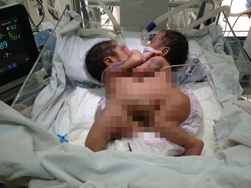 Hai bé sơ sinh dính liền: Một bé có hiện tương hoại tử ruột