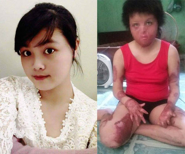 Nguyễn Thùy Dung rất xinh đẹp nhưng sau khi thiêu sống khuôn mặt và cơ thể em bị biến dạng nặng nề.