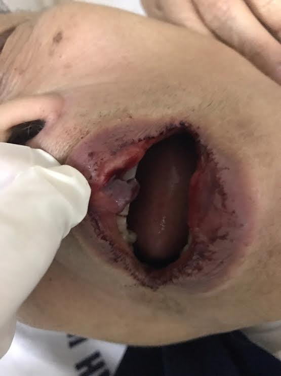 Vết thương trên miệng tiến sĩ Kh. (Ảnh: Facebook).