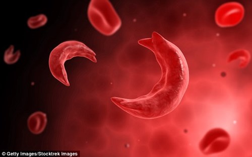 Bệnh thiếu máu do hồng huyết cầu hình lưỡi liềm khiến các tế bào hồng cầu bị bẻ cong thành hình lưỡi liềm. 