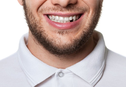 (Cấy ghép Implant ETK Active có thể áp dụng cho nhiều trường hợp mất răng)