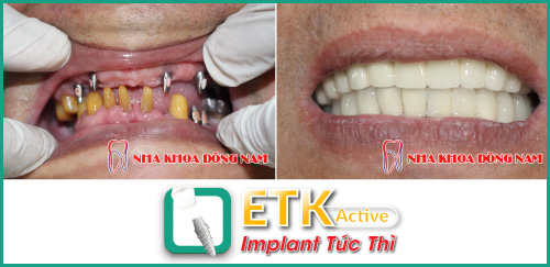  (Kết quả cấy ghép Implant ETK Active tại Nha Khoa Đông Nam)