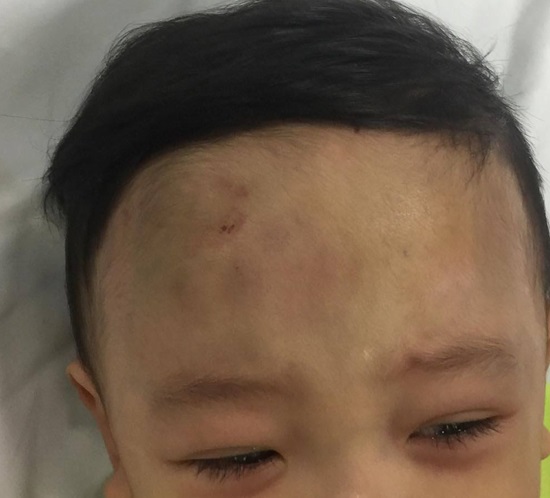 Hà Nội: Bé trai nghi bị bạo hành khiến tụ máu não, chảy máu bộ phận sinh dục
