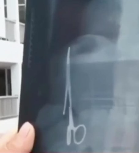 Các bác sĩ đã để quên chiếc panh chuyên dùng để mổ trong bụng ông Ma Văn Nhật (Bắc Kạn) khi ông này bị tai nạn giao thông cách đây 18 năm. Sự việc chỉ được phát hiện khi gần đây ông bị một tai nạn và đến bệnh viện kiểm tra thì phát hiện trong bụng có một chiếc kéo dài 15cm. (Nguồn Oddee)