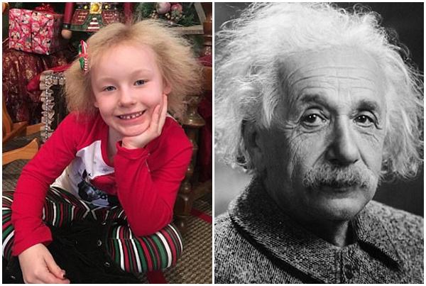 Bé gái 6 tuổi có mái tóc &quot;bất trị&quot; như thiên tài Einstein vì mắc hội chứng cực hiếm