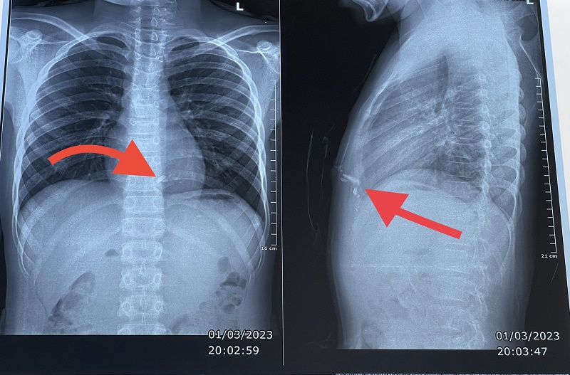 Hình ảnh 2 dị vật kim loại trong lồng ngực nằm sau xương ức bên trái của bệnh nhân - ảnh do bệnh viện cung cấp