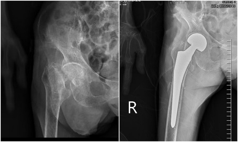 Hình ảnh chụp X-quang trước và sau khi thay khớp háng nhân tạo
