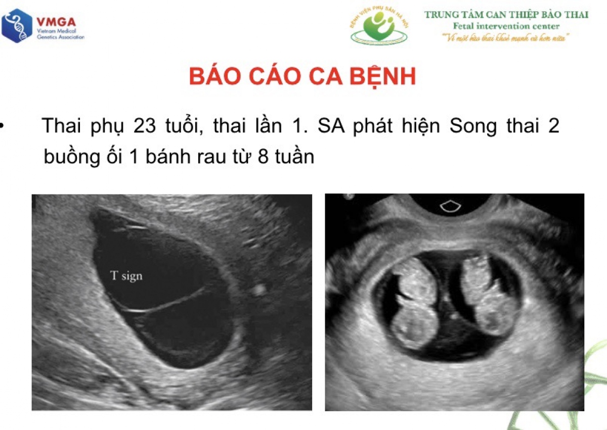 Việt Nam vừa xuất hiện một trường hợp độc nhất khi có hai em bé song thai cùng trứng khác giới tính. Hãy xem ảnh siêu âm thai đôi 7 tuần của cặp bé này để cùng chia sẻ niềm vui của gia đình và khám phá tuyệt phẩm của thiên nhiên.
