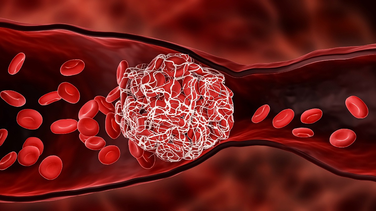 F0 khỏi COVID-19 bị tổn thương thành mạch máu sẽ làm tăng nguy cơ hình thành cục máu đông.