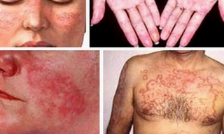Bệnh lupus ban đỏ nguy hiểm hơn bạn nghĩ