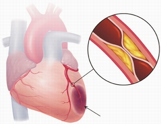 Những nguy cơ khiến bạn mắc bệnh tim mạch