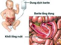 &quot;Thủ phạm&quot; gây lồng ruột ở trẻ em