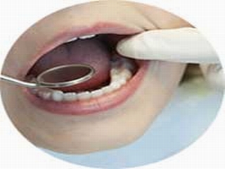 Bệnh nha chu: Có thế gây mất răng
