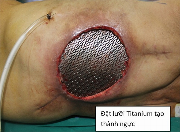 Đặt ưới Titanium tạo khung thành ngực cho bệnh nhân sau khi cắt khối u hoại tử.