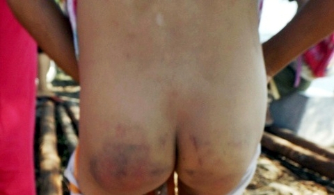 Một học sinh bị cô Thảo dánh bầm tím mông.
