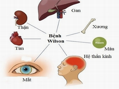 Hơn 2.000 người Việt mắc bệnh Wilson