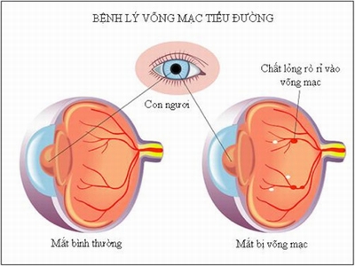 Biến chứng đáy mắt của bệnh đái tháo đường