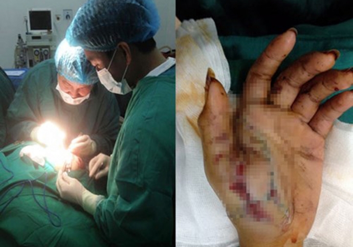 Bác sĩ tiến hành phẫu thuận tay cho bệnh nhi tổn thương do đốt pháo.