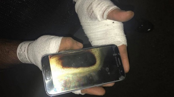 Amarjit Mann với đôi tay bị bỏng do chiếc Galaxy S7 của mình bất ngờ phát nổ