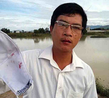 Ông Hoàng Trung Thành - Phó Chủ tịch UBND xã Gia An, huyện Tánh Linh bị thương chảy máu ở miệng - Ảnh: Quang Hưng/Tuổi Trẻ