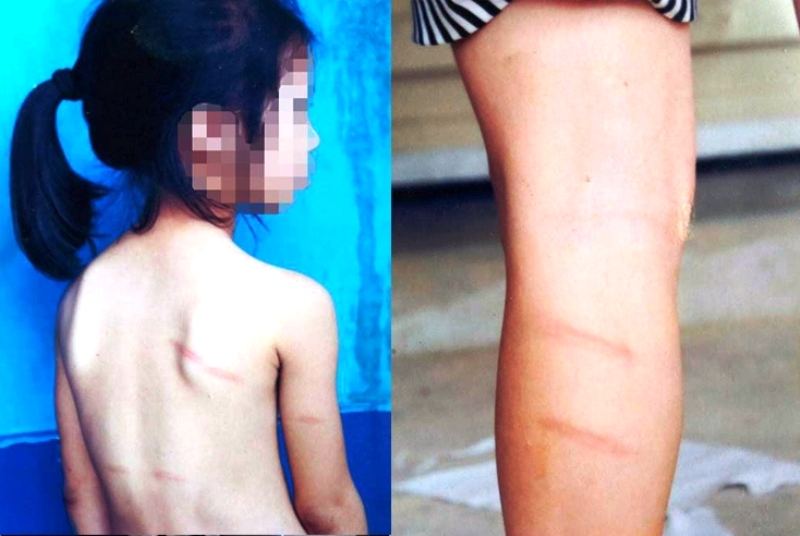 Nghệ An: Cô giáo đánh học sinh thâm tím lưng và chân vì không làm được bài