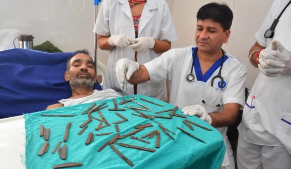 Năm 2016, các bác sĩ phẫu thuật tại một bệnh viện ở huyện Gurdaspur (Bắc Ấn Độ) đã lấy ra 40 con dao kim loại từ bụng một người đàn ông 42 tuổi không rõ danh tính. Được biết, anh ta đã nuốt đủ loại dao từ dao xếp, dao cũ, dao gỉ sét trong vòng hai tháng. (Nguồn Oddee)