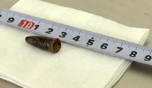 Một người đàn ông đã sống gần 20 năm với một chiếc nắp bút nhựa trong phổi. Sự việc chỉ được phát hiện khi ông này bị ho ra máu và đến bệnh viện kiểm tra. (Nguồn Oddee)