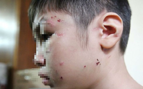 Đề nghị khởi tố vụ b​é trai 10 tuổi bị mẹ kế bạo hành ở Hà Nội