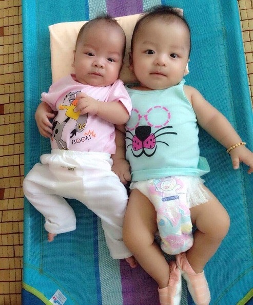 “Khoảng cách” của 2 bé khi Hoàng Thiên (trái) mới ghép tế bào gốc hồi tháng 4/2017.